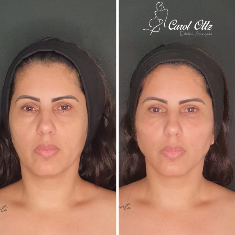 HARMONIZAÇÃO FACIAL