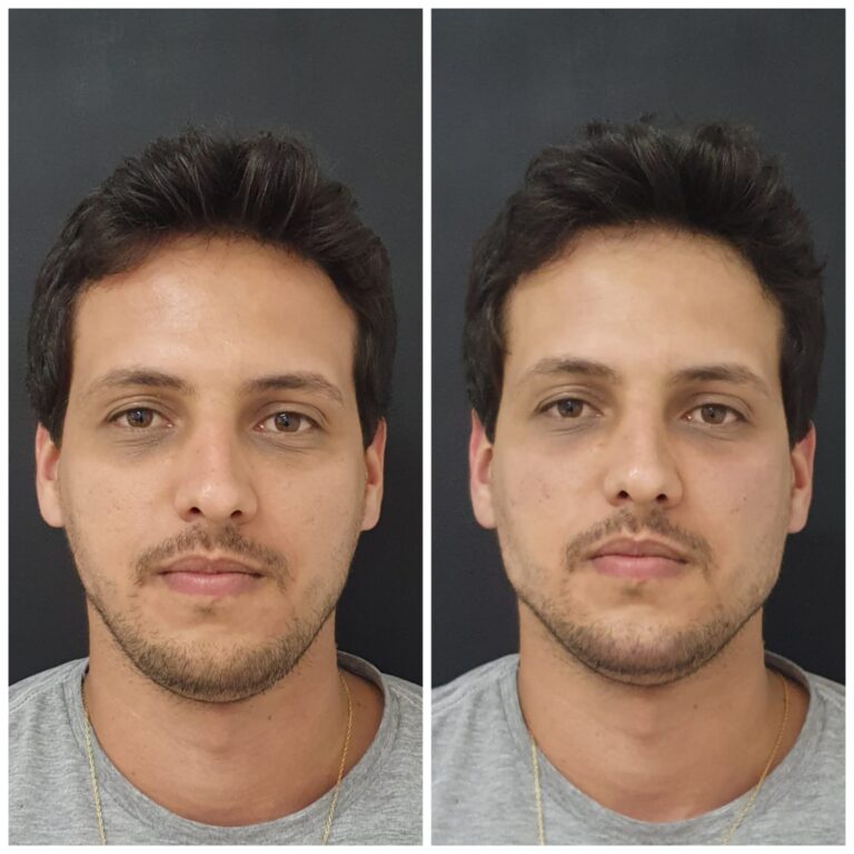 HARMONIZAÇÃO FACIAL