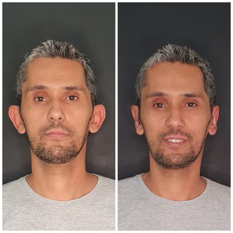 CORREÇÃO DE ORELHAS