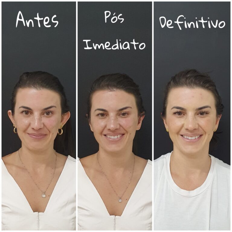 CORREÇÃO DE ORELHAS