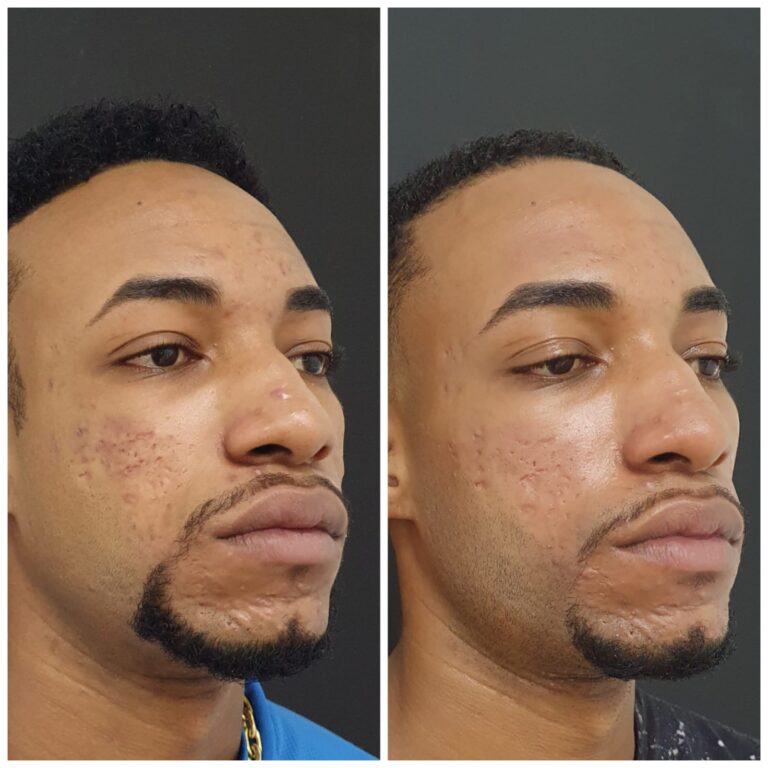 REVITALIZAÇÃO FACIAL C.OTTZ